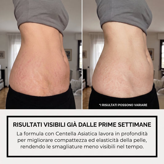 Siero anti smagliature