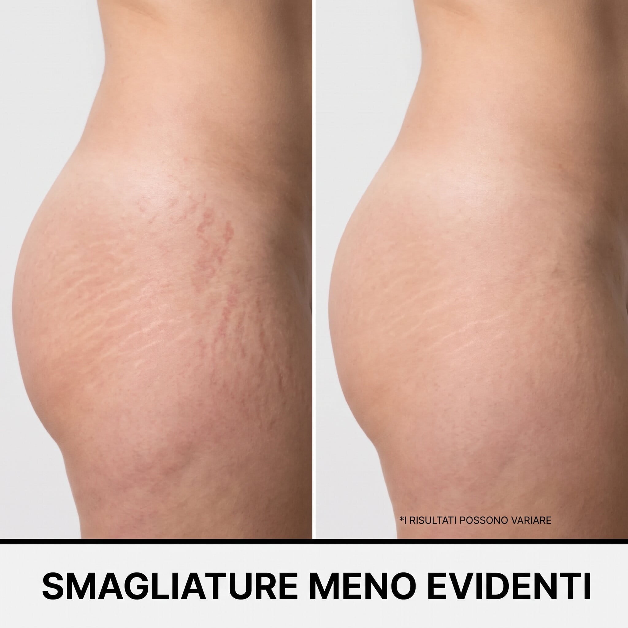 Siero anti smagliature