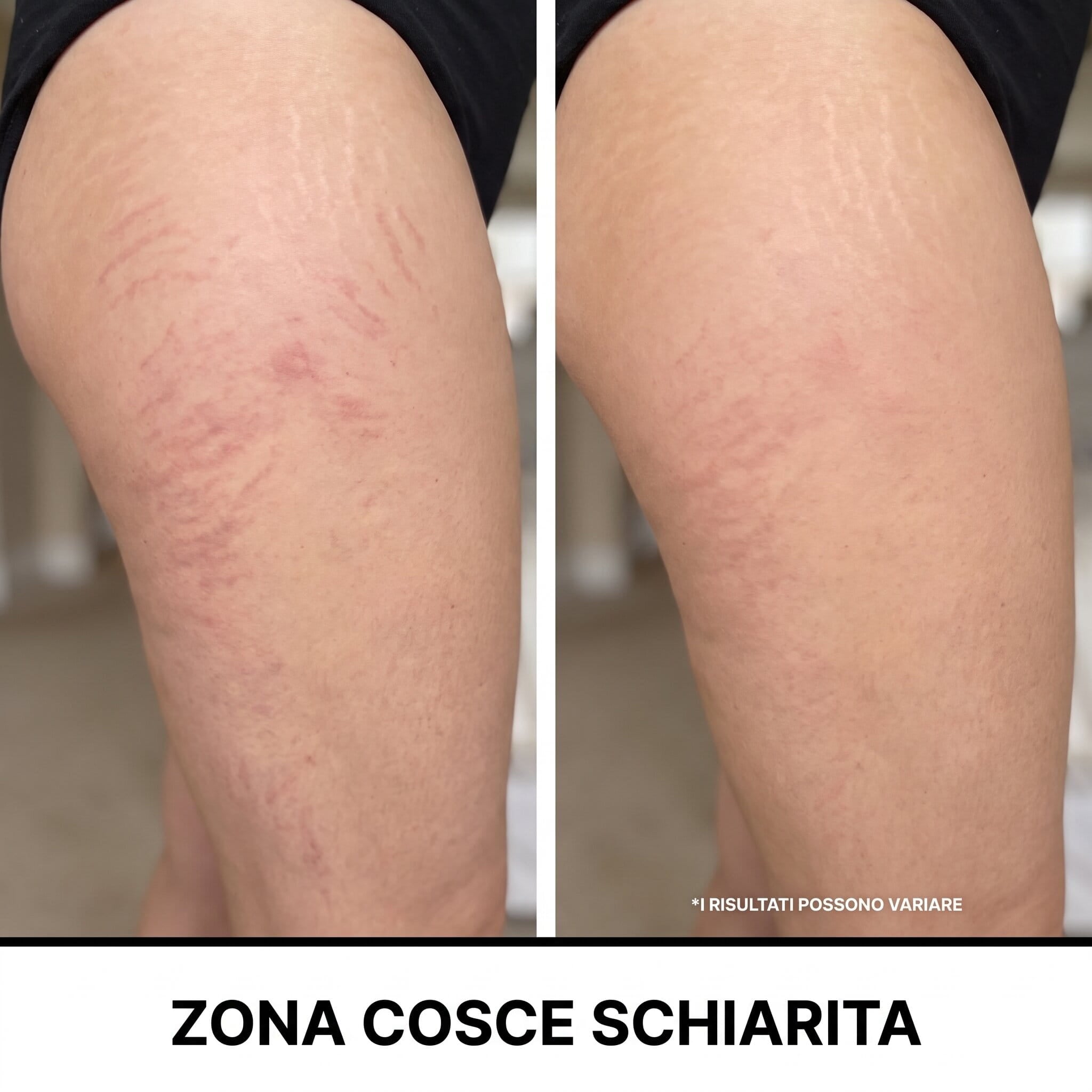 Siero anti smagliature